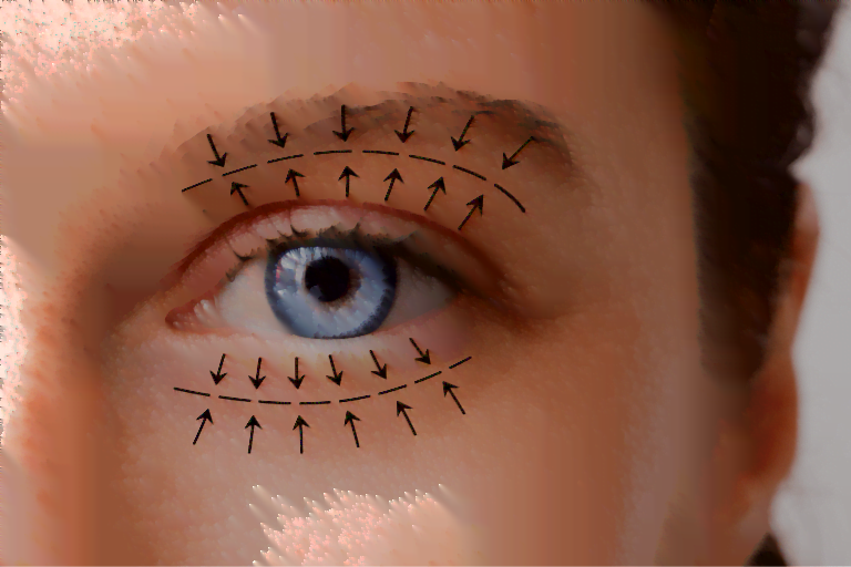 Zbliżenie na kobiece oko z narysowanymi liniami i strzałkami - plastyka powiek