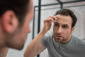 Mężczyzna ogląda w lustrze swoje zakola - wypadanie włosów